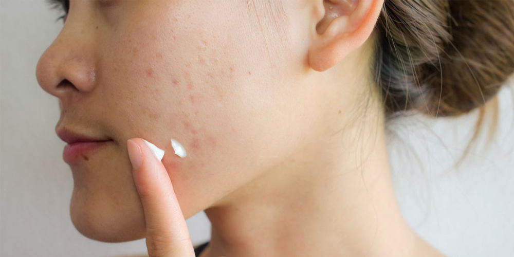  Best Medicinal Creams To Treat Pimples