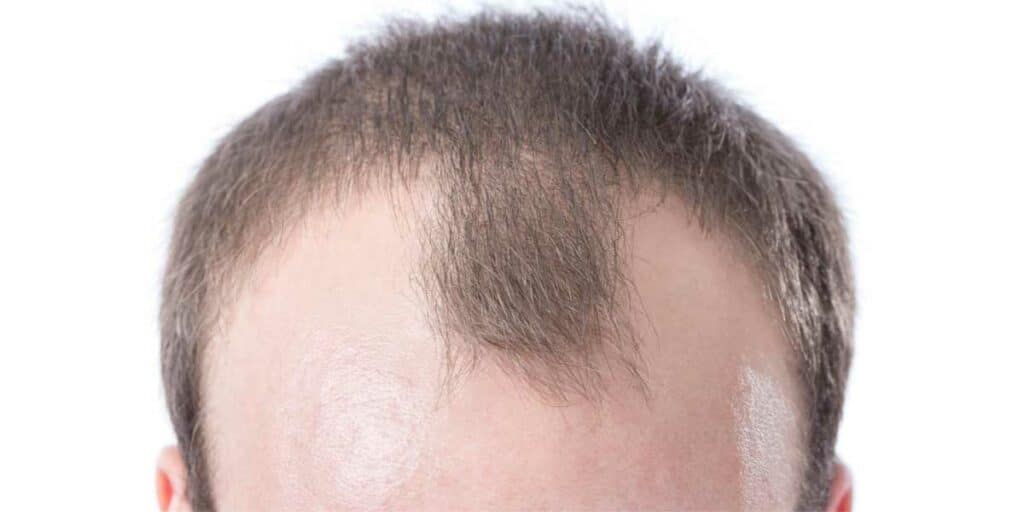 Prevents Baldness