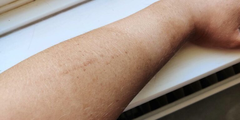 How to Remove Tan from Arms|Natural Remedies