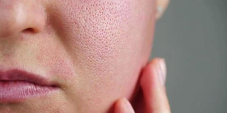 How To Minimize And Clear Open Pores in Face